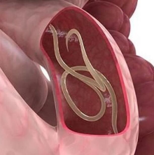 Signos de vermes nunha persoa no tracto gastrointestinal